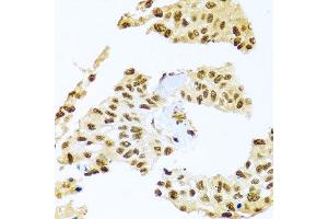 Immunohistochemistry of paraffin-embedded human lung cancer using SMEK1 antibody at dilution of 1:100 (x40 lens). (SMEK1 anticorps)