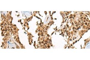 Immunohistochemistry of paraffin-embedded Human ovarian cancer tissue using ATE1 Polyclonal Antibody at dilution of 1:60(x200) (ATE1 anticorps)