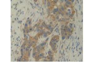 IHC-P analysis of Human Breast Cancer Tissue, with DAB staining. (IL12A anticorps  (AA 23-219))
