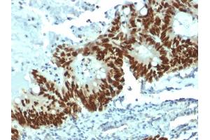 Formalin-fixed, paraffin-embedded human Colon Carcinoma stained with p53 Mouse Monoclonal Antibody (DO-1).