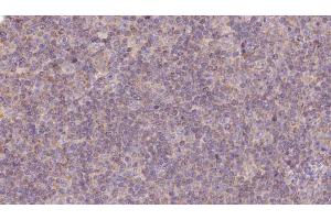 ABIN6273125 at 1/100 staining Human lymph cancer tissue by IHC-P. (HPS5 anticorps  (Internal Region))