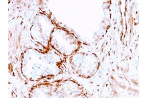 Formalin-fixed, paraffin-embedded human Prostate Tumor stained with AKR1B1 Mouse Monoclonal Antibody (CPTC-AKR1B1-3). (AKR1B1 anticorps)