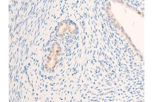 ABIN6267284 at 1/100 staining rat uterine cancer tissue sections by IHC-P. (ErbB2/Her2 anticorps  (pTyr877))