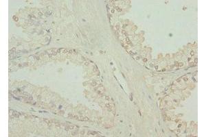 Immunohistochemistry of paraffin-embedded human prostate cancer using ABIN7173754 at dilution of 1:100 (TBCE anticorps  (AA 328-527))