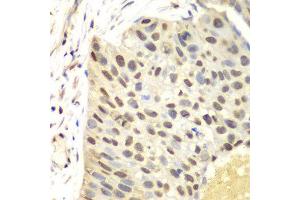 Immunohistochemistry of paraffin-embedded human lung cancer using FEN1 antibody at dilution of 1:100 (400x lens). (FEN1 anticorps)