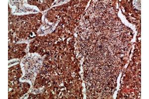 Immunohistochemical analysis of paraffin-embedded human-lung-cancer, antibody was diluted at 1:200 (IMP3 anticorps  (AA 135-184))