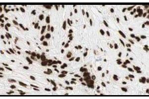 Affinity Purified anti-Gli2 antibody shows strong cytoplasmic and membranous staining of tumor cells in human breast tissue. (GLI2 anticorps  (Internal Region))