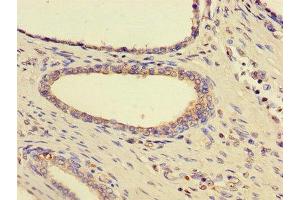 Immunohistochemistry of paraffin-embedded human prostate cancer using ABIN7170815 at dilution of 1:100