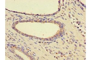 Immunohistochemistry of paraffin-embedded human prostate cancer using ABIN7170815 at dilution of 1:100 (HSPA9 anticorps  (AA 458-679))