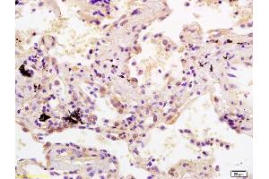 Formalin-fixed and paraffin embedded human lung carcinoma labeled with Rabbit Anti SDHC Polyclonal Antibody, Unconjugated (ABIN1385318) at 1:200 followed by conjugation to the secondary antibody and DAB staining (SDHC anticorps  (AA 81-169))