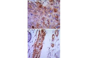 Immunohistochemical analysis of paraffin-embedded human lung cancer (A) and colon cancer (B) using VCAM1 monoclonal antobody, clone 6G9  with DAB staining. (VCAM1 anticorps)