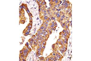 (ABIN390138 and ABIN2840642) staining P14 in human lung adenocarcinoma tissue sections by Iunohistochemistry (IHC-P - paraformaldehyde-fixed, paraffin-embedded sections).