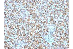 Formalin-fixed, paraffin-embedded human Melanoma stained with MCAM Mouse Monoclonal Antibody (MCAM/3048). (MCAM anticorps  (AA 226-374))