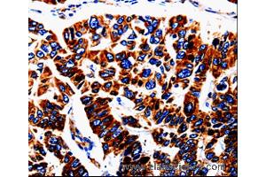 Immunohistochemistry of Human lung cancer using UTS2 Polyclonal Antibody at dilution of 1:50 (Urotensin 2 anticorps)