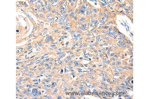 Immunohistochemistry of Human esophagus cancer using MVP Polyclonal Antibody at dilution of 1:30 (MVP anticorps)