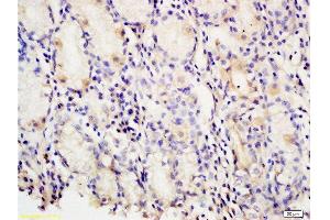 Formalin-fixed and paraffin embedded human gastric carcinoma tissue labeled with Anti-PAF Polyclonal Antibody, Unconjugated at 1:200 followed by conjugation to the secondary antibody and DAB staining (KIAA0101 anticorps)