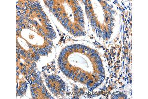 Immunohistochemistry of Human ovarian cancer using IGFBP7 Polyclonal Antibody at dilution of 1:50 (IGFBP7 anticorps)