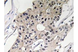 Immunohistochemistry analyzes of Defensin alpha-1 antibody in paraffin-embedded human breast carcinoma tissue. (alpha Defensin 1 anticorps)
