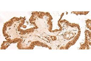 Immunohistochemistry of paraffin-embedded Human thyroid cancer tissue using ARMC8 Polyclonal Antibody at dilution of 1:40(x200) (ARMC8 anticorps)