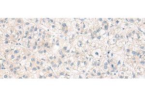Immunohistochemistry of paraffin-embedded Human liver cancer tissue using ANKS6 Polyclonal Antibody at dilution of 1:55(x200) (ANKS6 anticorps)
