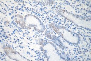 Immunohistochemistry was performed on paraffin-embedded human gastric carcinoma using DDB2 antibody (ABIN7798274), 1:200). (Recombinant DDB2 anticorps)