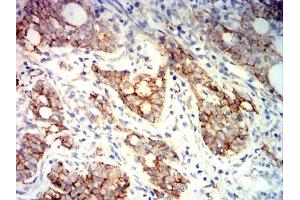 Immunohistochemical analysis of paraffin-embedded cervical cancer tissues using CTNNB1 mouse mAb with DAB staining.
