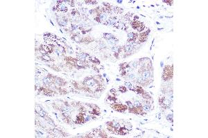 Immunohistochemistry of paraffin-embedded human liver cancer using Mineralocorticoid receptor (NR3C2) Rabbit pAb (ABIN1681109, ABIN3017672, ABIN3017673 and ABIN6220207) at dilution of 1:100 (40x lens).