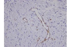 IHC-P Image Immunohistochemical analysis of paraffin-embedded human Sarcoma meta to brain Blood Vessel, using CORO1C , antibody at 1:100 dilution.