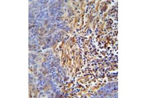 Immunohistochemistry analysis in formalin fixed and paraffin embedded human lung carcinoma reacted with HLA-DRB5 Antibody (Center) followed which was peroxidase conjugated to the secondary antibody and followed by DAB staining.