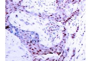 Immunohistochemistry analysis of paraffin-embedded human breast carcinoma tissue with PRNP (phospho S190) polyclonal antibody . (PRNP anticorps  (pSer190))