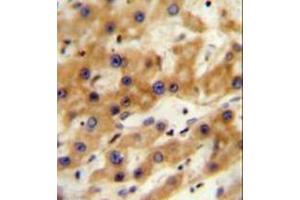Immunohistochemistry analysis in formalin fixed and paraffin embedded human hepatocarcinoma reacted with GAGE13 Antibody (N-term) followed by peroxidase conjugation of the secondary antibody and DAB staining. (G Antigen 13 anticorps  (N-Term))