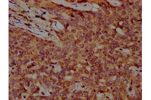 IHC image of ABIN7152402 diluted at 1:500 and staining in paraffin-embedded human liver cancer performed on a Leica BondTM system.