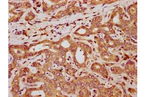 IHC image of ABIN7161592 diluted at 1:300 and staining in paraffin-embedded human liver cancer performed on a Leica BondTM system. (QPRT anticorps  (AA 113-254))