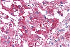 Human Adrenal Medulla (formalin-fixed, paraffin-embedded) stained with USP20 antibody ABIN213605 at 10 ug/ml followed by biotinylated goat anti-rabbit IgG secondary antibody ABIN481713, alkaline phosphatase-streptavidin and chromogen.