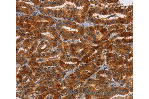 Immunohistochemistry of Human liver cancer using NCR1 Polyclonal Antibody at dilution of 1:30 (NCR1 anticorps)