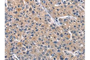 The image on the left is immunohistochemistry of paraffin-embedded Human liver cancer tissue using ABIN7128963(CLEC2D Antibody) at dilution 1/70, on the right is treated with fusion protein.