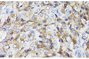 Immunohistochemistry of paraffin-embedded Human lung cancer using CD59 Polyclonal Antibody at dilution of 1:100 (40x lens).