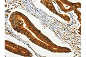 The image on the left is immunohistochemistry of paraffin-embedded Human colon cancer tissue using ABIN7190246(CHRDL2 Antibody) at dilution 1/20, on the right is treated with synthetic peptide. (CHRDL2 anticorps)