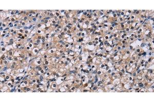 Immunohistochemistry of paraffin-embedded Human prostate cancer tissue using NR1D1 Polyclonal Antibody at dilution 1:60 (NR1D1 anticorps)