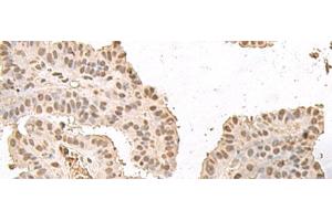 Immunohistochemistry of paraffin-embedded Human thyroid cancer tissue using HMGN2 Polyclonal Antibody at dilution of 1:35(x200) (HMGN2 anticorps)