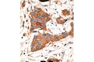 Formalin-fixed and paraffin-embedded human cancer tissue reacted with the primary antibody, which was peroxidase-conjugated to the secondary antibody, followed by DAB staining.