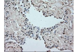 Immunohistochemical staining of paraffin-embedded Adenocarcinoma of breast tissue using anti-SATB1 mouse monoclonal antibody.