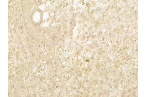 ABIN6260825 and ABIN6277501 at 1/100 staining human astrocytoma by IHC-P. (CHRNB1 anticorps  (N-Term))