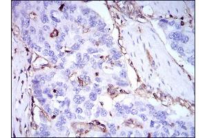 Immunohistochemical analysis of paraffin-embedded esophageal cancer tissues using B2M mouse mAb with DAB staining.