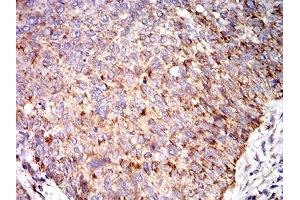 Immunohistochemical analysis of paraffin-embedded bladder cancer tissues using C3C mouse mAb with DAB staining. (Complement C3c anticorps  (AA 1521-1649))
