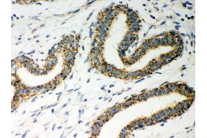 Anti- ERAB Picoband antibody,IHC(P) IHC(P): Human Mammary Cancer Tissue