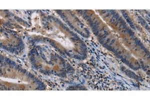 Immunohistochemistry of paraffin-embedded Human colon cancer tissue using ITPR2 Polyclonal Antibody at dilution 1:40 (ITPR2 anticorps)