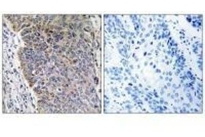 Immunohistochemistry analysis of paraffin-embedded human lung carcinoma tissue using MGST3 antibody. (MGST3 anticorps)