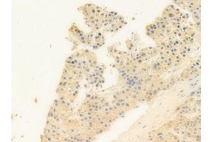 ABIN6258807 and ABIN6273863 at 1/100 staining human hepatocellular carcinoma by IHC-P. (GPR25 anticorps  (Internal Region))
