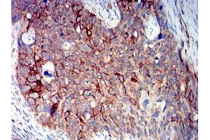 Immunohistochemical analysis of paraffin-embedded cervical cancer tissues using BCL2L10 mouse mAb with DAB staining. (BCL2L10 anticorps  (AA 31-186))